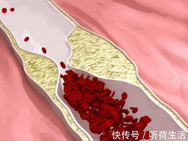 脂蛋白颗粒|血脂报告中除了“坏”胆固醇，还应该关注什么？