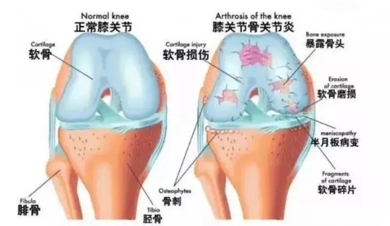 骨关节炎|60岁后，八成人软骨磨得只剩一半！简单一招，养关节，护骨骼