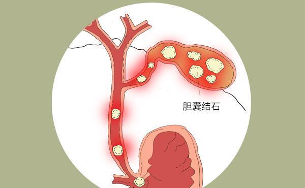 癌症|从确诊到离开仅三个月,凶险程度高的胆管癌就预防不了吗?