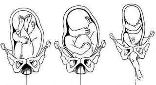 宫颈|分娩时,出现以下8种情况的产妇务必选择剖腹产,千万别犹豫误事