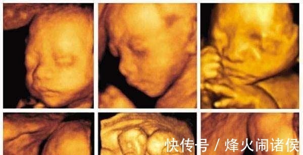 胎盘|四维彩超那么贵, 不懂这些就白做了 3分钟让读懂报告单!