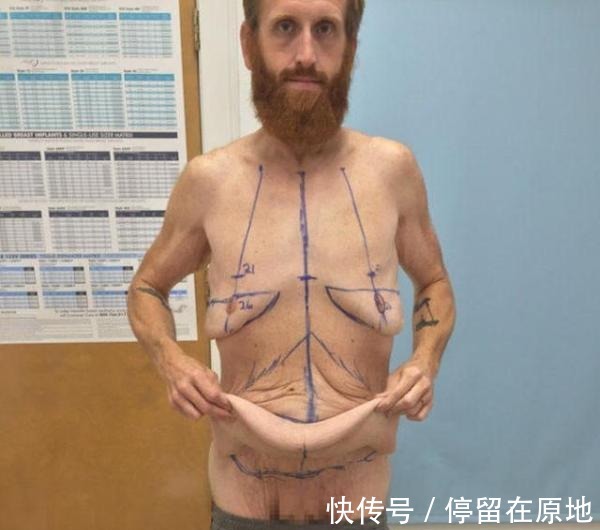 男子|男子体重420斤,两年时间怒减320斤,减肥前后判若两人!