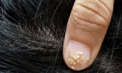 头发上“白泥”增多,或是“它”在作祟,做好4件事,慢慢减少