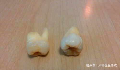 牙龈|拔牙后缝合伤口的线需要拆除吗