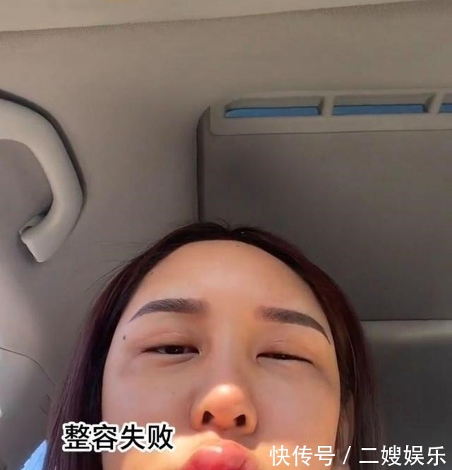 东北女孩 8年的整形手术花费了100多万,光额头就打了200多支玻尿酸