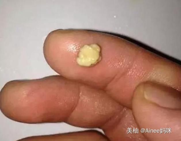 口腔卫生|儿子被同学嫌“嘴太臭”,宝妈带孩子去医院,取出的东西真的臭