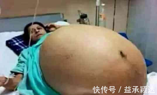 女子|印度一女子一胎怀了11个婴儿,不得已医院安排多位医生为其接生