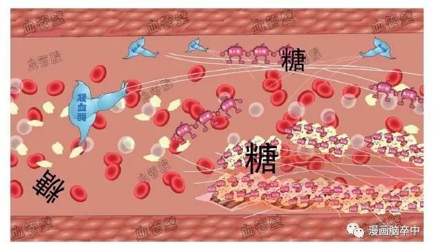 高血压|太形象！2分钟看懂脑卒中