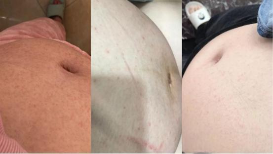 这些事|怀了两胎都没长妊娠纹？孕期三阶段做好这些事，花肚皮远离你