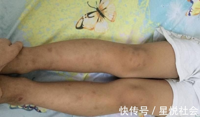 缺钙|孩子缺钙时,身体会出现4种信号,多给孩子吃3物,补钙质长个高