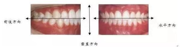 夜磨牙|夜晚磨牙伤的不只是牙，还要当心脸“变形”？