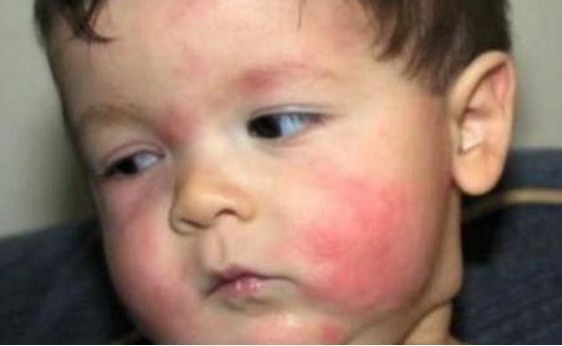 肉毒杆菌|一碗粥竟差点要了8个月孩子的命,儿科医生宝宝进食需要谨慎!