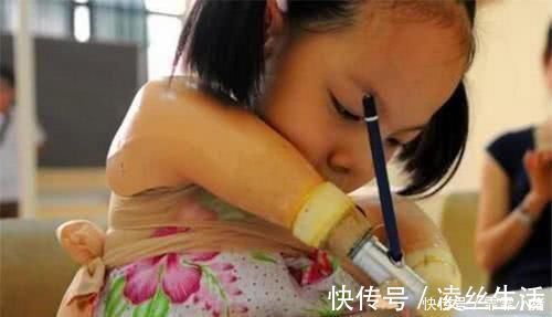 李女士|孕检发现孩子没有手脚,妈妈却坚持和医生说“生”,如今活成公主