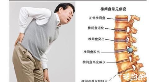 腰椎|腰椎间盘突出怎么办大黄+生姜可针对,用了都说好!