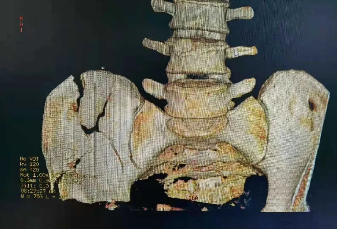 胆囊切除|山东第一医科大学附属省立医院成功救治一名高空坠落伤患者