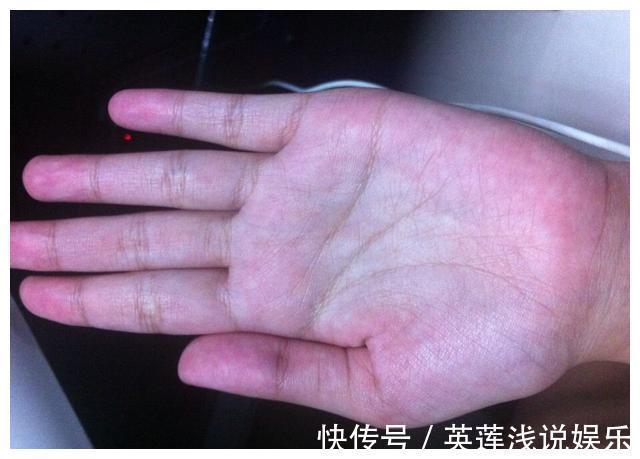 慢性肝炎|体内有“癌”,手脚先知!医生提醒:手脚出现这4种变化,不要拖