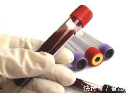 血管内皮|甘油三酯高的人,就会长颈动脉斑块吗?为何有人不高也会长斑块?