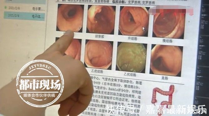 小海|男孩1岁就开始拉肚子,每天十几次,直到12岁才找到病因