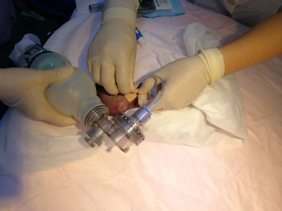 23+4周早产,体重450克,这位宝宝刷新山东存活新生儿记录