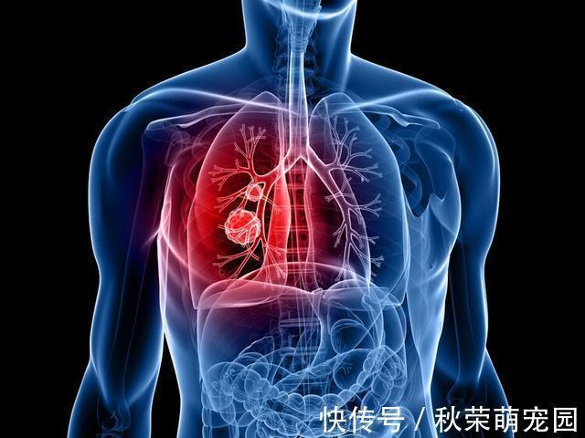 颈椎病|男子肩背痛了三个月,以为颈椎病复发,检查发现是肺癌“捣鬼”