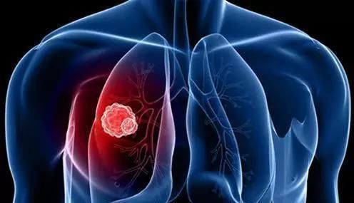 形态|钙化是癌变的信号和哪些癌症息息相关呢