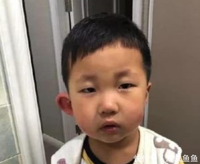 花露水|宝宝被蚊子咬成“大耳朵图图”,又疼又痒还留疤,怎么处理最好?