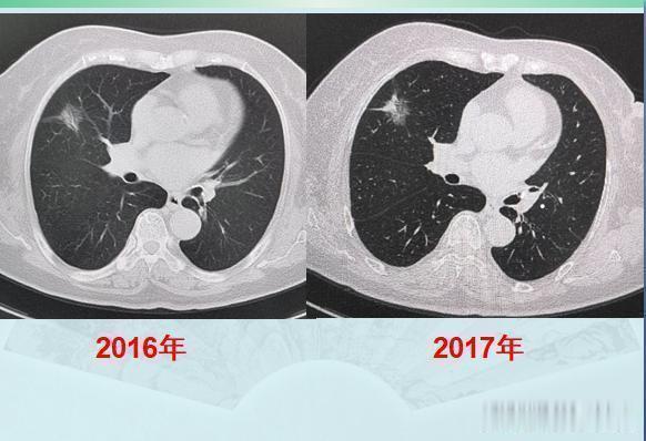 原发灶|两个肺癌病人都拖了2年才治疗,一个治愈,一个扩散了