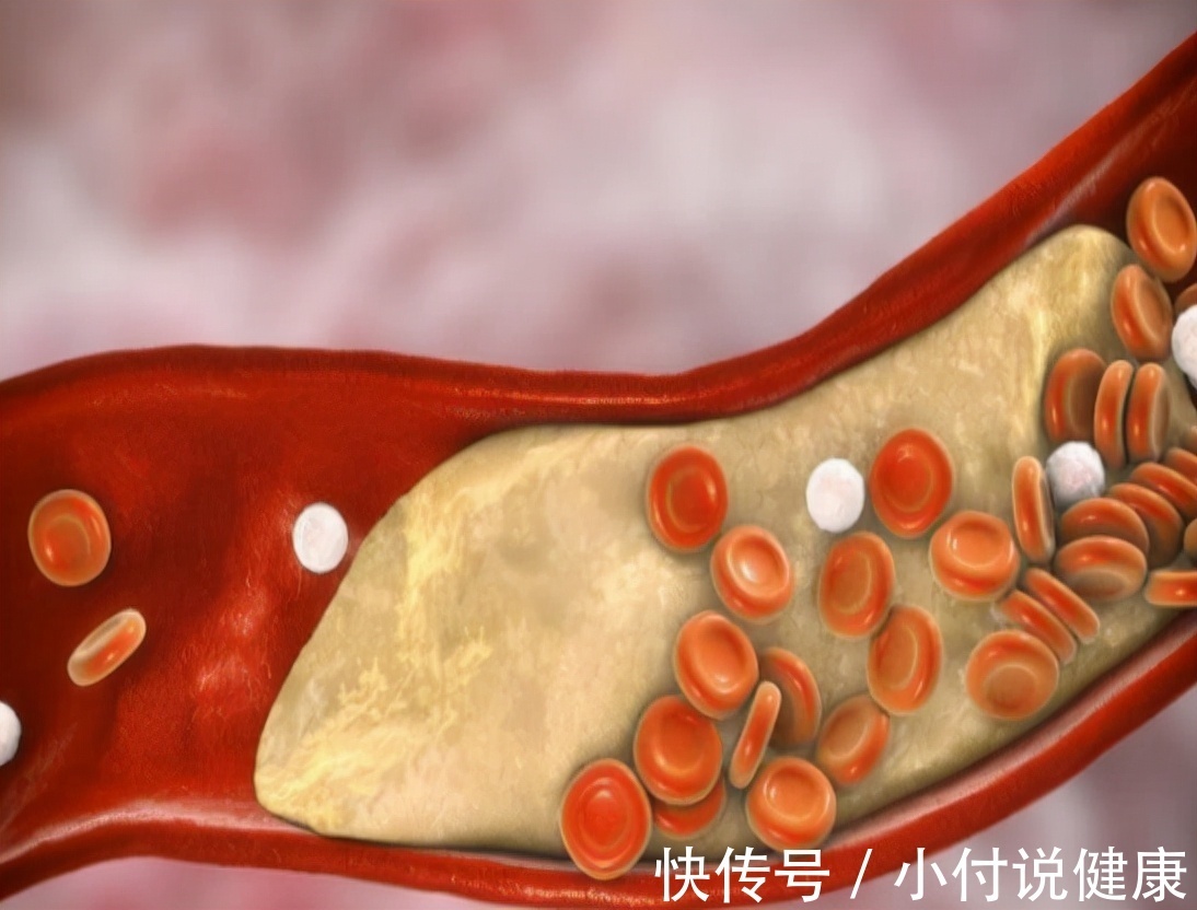 睡眠时间|胆固醇、甘油三酯、脂蛋白超标?血脂与日常饮食关系多大?如何调