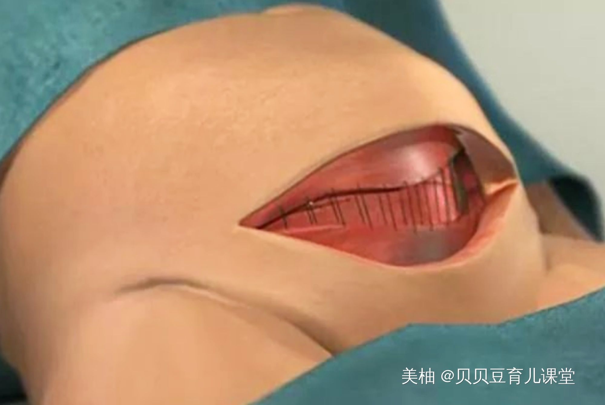 流程图|看过这几张剖腹产模拟流程图,产妇更害怕了,网友确实很形象