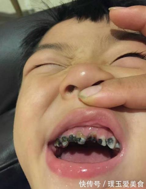 牙齿|为什么越来越多孩子满口黑牙?主因不是糖果,而是无知的父母