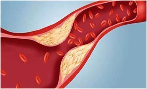 运动|77岁老人血脂从7.3到1，分享：降血脂不是多运动，而是坚持3件事