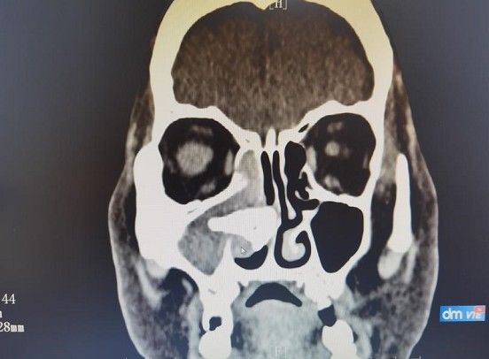 流涕|老人常年鼻塞流涕，近期突然流“血涕”，元凶竟是一块“石头”