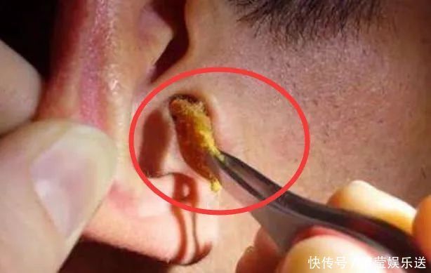 为啥有人耳屎又湿又油,有人却“干巴巴”的?3个原因,早自检!