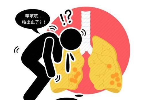  早期|肺癌本可治，重在早发现！早期肺癌的6个信号，你不可不知