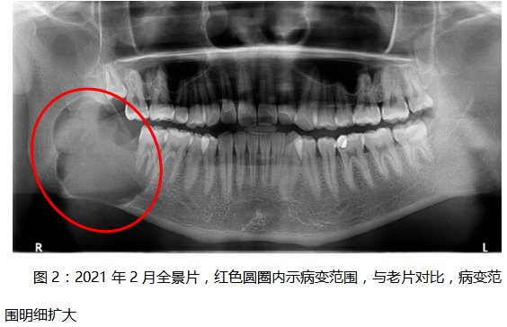 种植|市中心医院口腔科成功完成一例下颌骨成釉细胞瘤扩大切除后双层腓骨移植联合牙种植手术