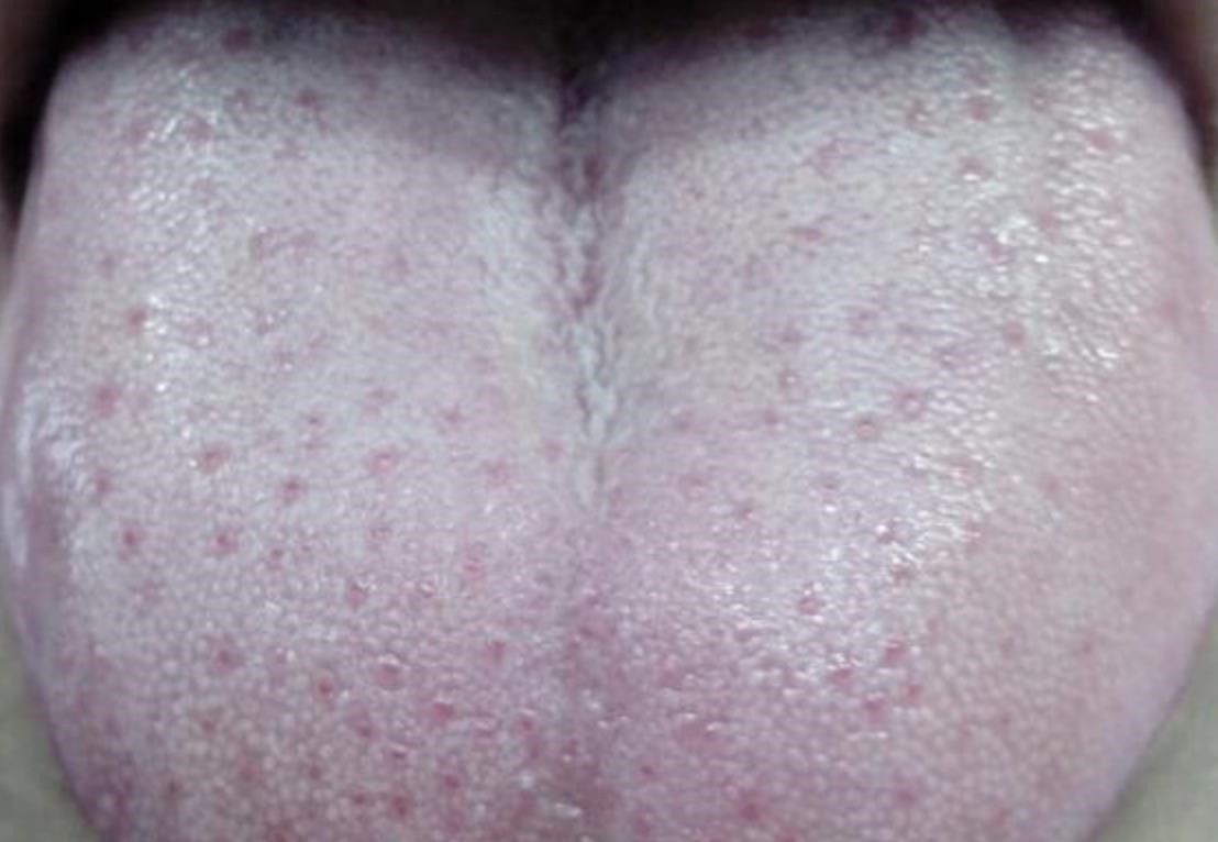 保健食品|老是放屁估计是脾虚了,1个小方子,健脾养胃,湿气不来扰