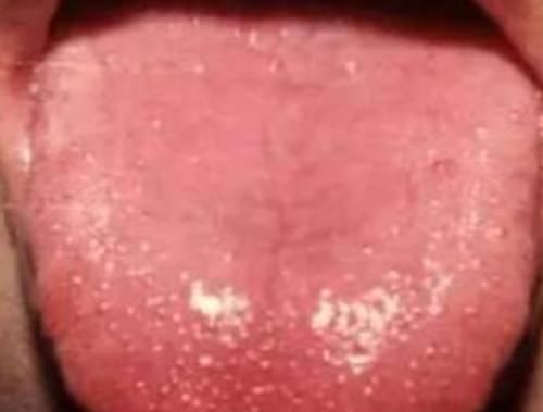 血热|血热还是血寒?看舌象自查!已对比解释