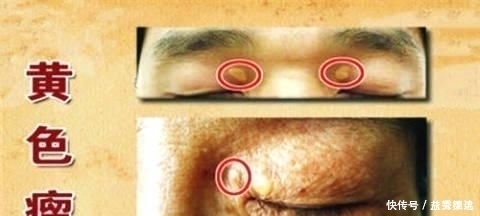 中医院士1个食疗方,开水里放1物,血管干净、高血脂降了