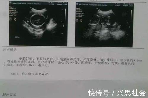 胎儿|刚怀孕,第一次孕检别盲目,只要这3项指标正常,胎儿就是健康的