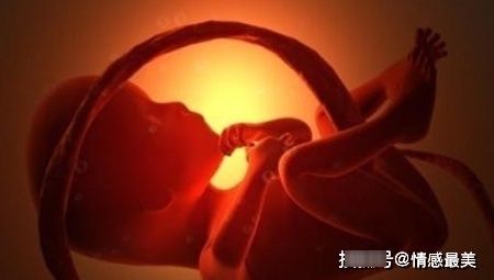 怀孕36周脐带绕颈3圈，羊水又偏少，该怎么办？