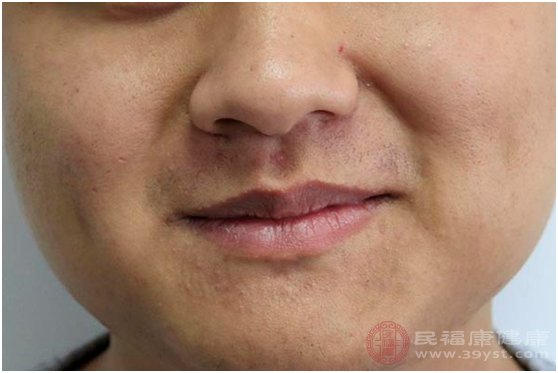 内分泌失调的痘痘怎么治疗