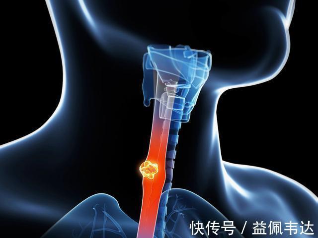 致癌物|吃东西总被噎到,小心食道癌!专家两个坏习惯得改改了