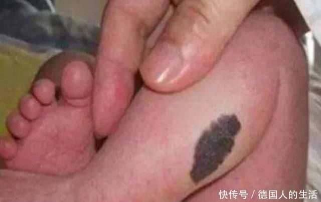 宝宝|孕妈在孕期,尽量不做4件事,避免宝宝脸上长胎记,孕妈别不在意