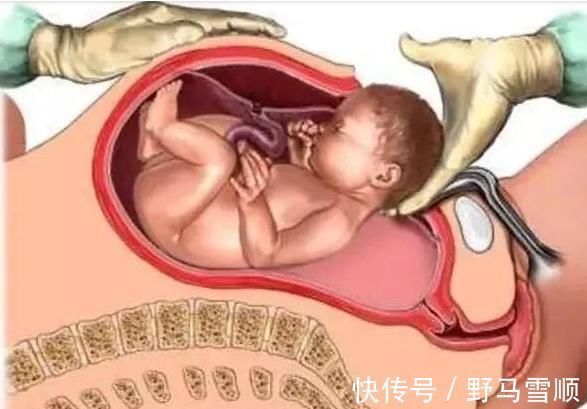 手术|第二次剖腹产真比第一次更疼?这里有标准答案,孕妈早知道早放心