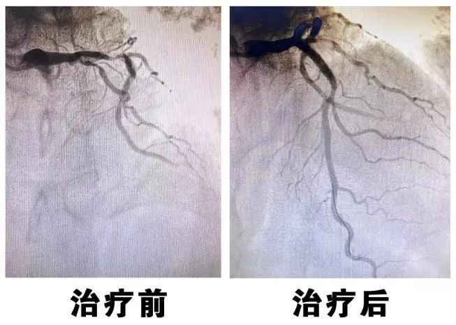 救治|北京怀柔医院胸痛中心打造高速“生命通道”