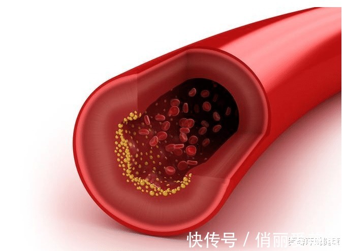 血脂异常|多走路可以降血脂?专家提醒:过了50岁,这3事或比运动更有效
