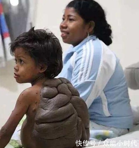 男孩|8岁男孩背上长出惊人大“龟壳”,酷似忍者神龟