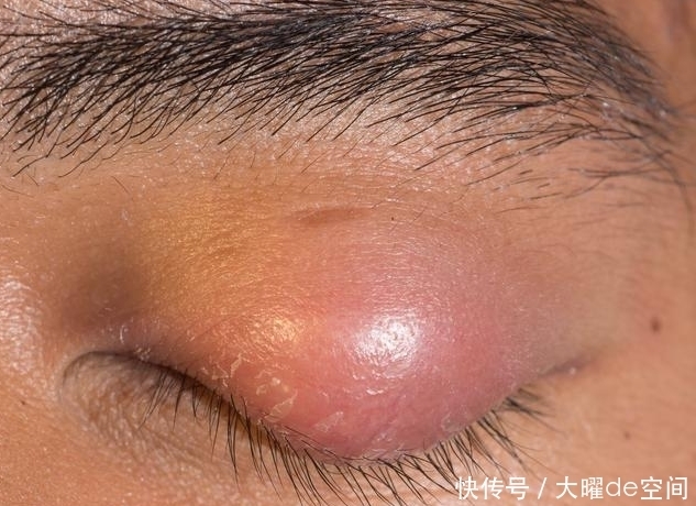 肺癌|肩膀这样疼痛时,是肺在向你发出“求救”信号,不能轻易忽视