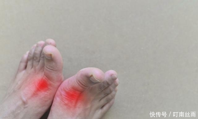 痛风|身体出现这1症状,痛风来了,它们泡水每天喝1杯,治痛风降尿酸