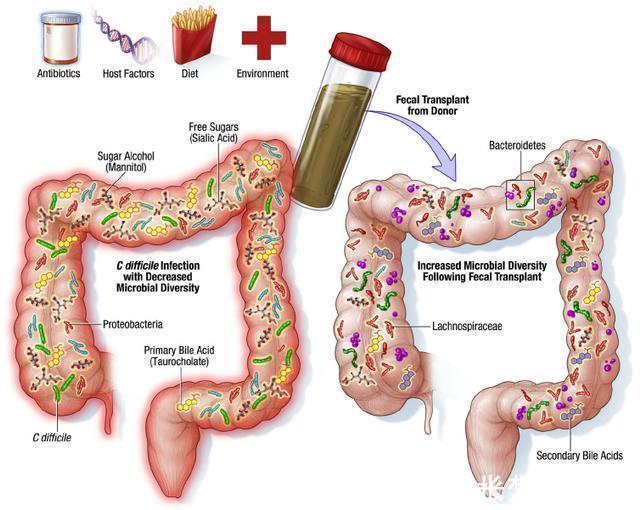 黑色素瘤|《科学》发表新研究，粪便移植可以治癌，粑粑入药原来是真的